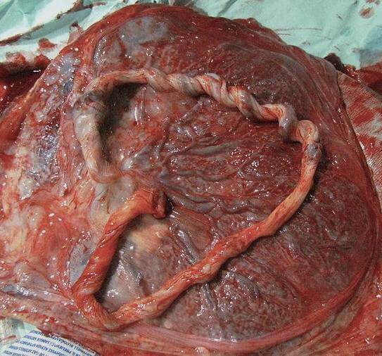Placenta